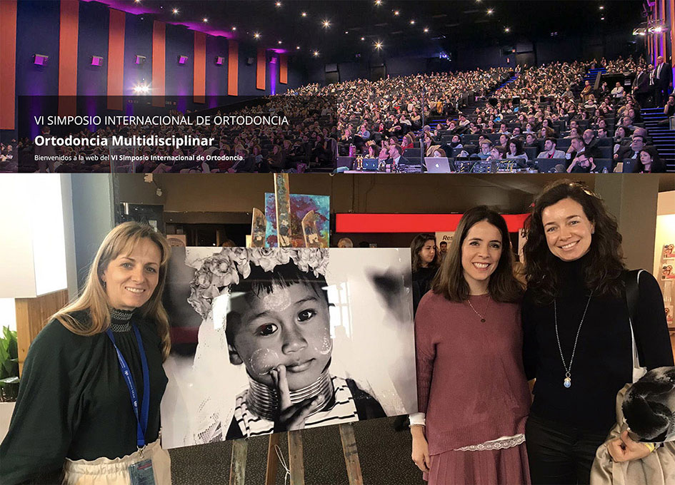 LA CLÍNICA DENTAL ESTHER MAJAN HA ESTADO PRESENTE EN EL SIMPOSIO INTERNACIONAL DE ORTODONCIA, CELEBRADO EN MADRID LOS DÍAS 6, 7 Y 8 DE FEBRERO DE 2020, DÓNDE SE HA DADO A CONOCER PROGRAMAS CIENTÍFICOS SOBRE LOS TRATAMIENTOS DE ORTODONCIA ORTODÓNCICOS MAS NOVEDOSOS EN EL MUNDO La clínica dental Esther Majan ha estado presente en el Simposio Internacional de Ortodoncia, celebrado en Madrid los días 6, 7 y 8 de Febrero de 2020, dónde se ha dado a conocer los diferentes programas científicos de alto nivel que existen al respecto del los tratamientos de ortodoncia ortodóncicos mas novedosos en el mundo, desde un aspecto multidisciplinario. En este sentido, hemos recibido una información esencial para seguir manteniendo el liderazgo técnico que siempre henos ofrecido a nuestros pacientes de ortodoncias. Actualmente en nuestros tratamientos de ortodoncia evaluamos las sonrisas en 3, e incluso en 4 dimensiones. Cuando se enlazan los conceptos de macroestética, miniestética y microestética pueden dar como resultado sonrisas que no son sólo un gran éxito para el clínico, sino lo más importante, lo son para el paciente y establecen un nivel de calidad superior en el diseño de sonrisas. En esta presentación, el Dr. Sarver basándose en los últimos avances en el diseño de la sonrisa hablará de la importancia de: • Scripting: cómo ilustrar de manera eficiente el plan de tratamiento a los pacientes y a sus padres. • Nuances: son los pequeños detalles en el diseño de la sonrisa los que hacen la diferencia. • Appearance: no es sólo la sonrisa, es el conjunto de la apariencia del paciente la clave del éxito final. • Presentation: el arte de la ilustración verbal y visual en la estética de la sonrisa. Actualmente la demanda de tratamientos con alineadores por parte de los adolescentes se ha incrementado considerablemente intentando buscar una mejor estética y comodidad frente a la aparatología fija existente. Las estrategias para abordar los tratamientos en estos pacientes depende de la edad y potencial de crecimiento, así como de la severidad que presente la maloclusión. Recientemete se ha descrito la posibilidad de realizar tratamientos de ortopedia de maloclusiones en el plano sagital en el paciente en crecimiento usando dispositivos de alineadores para poder llevar a cabo avances mandibulares con una nueva generación de activadores mandibulares. Estos nuevos dispositivos ofrecen múltiples ventajas sobre otros sistemas que existen actualmente. Permite la alineación dental al mismo tiempo que favorece el crecimiento de la mandíbula con un control vertical y la capacidad de estabilizar el incisivo inferior. La satisfacción del paciente es mayor comparado con otros sistemas porque estéticamente es más aceptado, más higiénico y cómodo. Sin embargo cuando estas maloclusiones aparecen asociadas a otras en diferentes planos, hay que tener claros los protocolos de actuación. De esta manera cuando aparece junto a una maloclusión transversal, a veces hay que establecer un protocolo donde se realiza previamente una expansión rápida del maxilar o para el control vertical en algunas ocasiones es necesario el uso de elementos auxiliares. El éxito del tratamiento de Ortodoncia depende de un diagnóstico adecuado, un plan de tratamiento correcto y una colaboración del paciente. En esta conferencia, se han presentado casos clínicos con la intención de determinar las indicaciones, posibilidades y límites que tiene en la actualidad el uso de alineadores dentales como aparato ortopédico en pacientes en crecimiento con problemas sagitales y Clínica Dental Esther Maján ha estado presente en tan importante conferencia celebrada en Madrid.