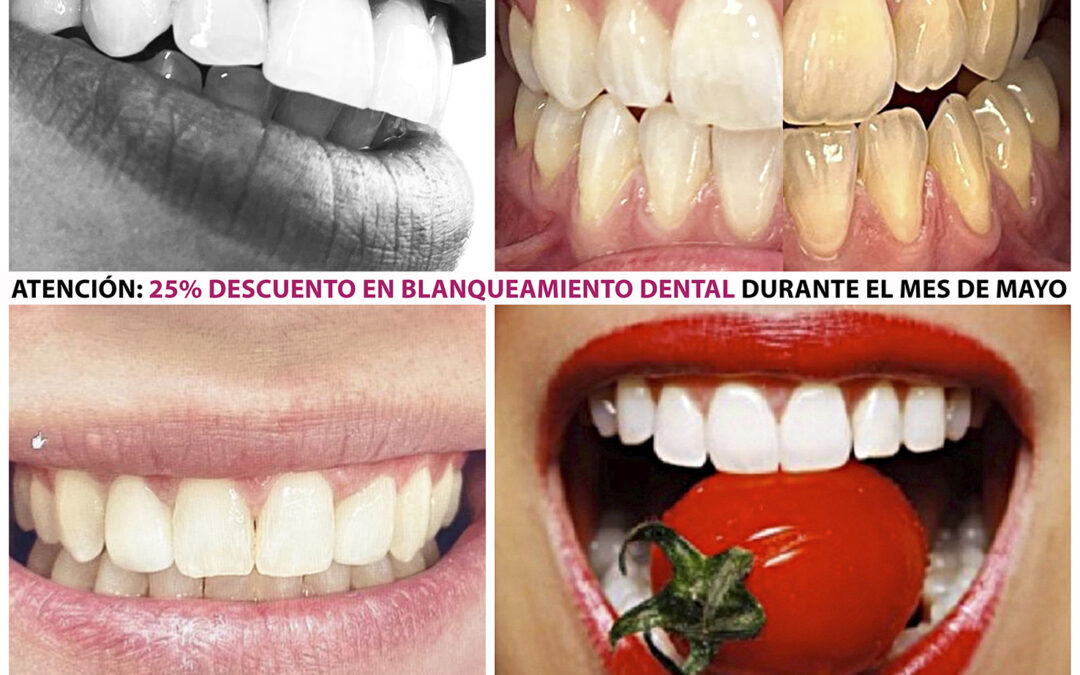 OFERTA PROMOCIÓN DEL 25% DE DESCUENTO EN TRATAMIENTOS DE BLANQUEAMIENTO DENTAL EN MÓSTOLES MADRID. OFERTAS PROMOCIONES DENTALES DE CLINICA DENTAL ESTHER MAJAN EN MÓSTOLES.