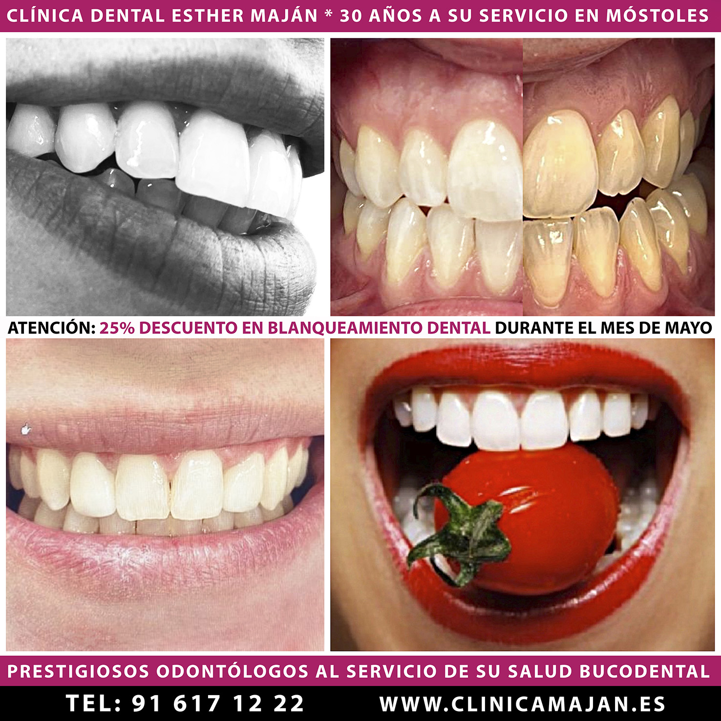 “ATENCIÓN OFERTA: 25% DE DESCUENTO EN BLANQUEAMIENTO DENTAL DEL 1 AL 31 DE MAYO”. EN CLÍNICA DENTAL ESTHER MAJÁN QUEREMOS PREMIAR A NUESTROS CLIENTES CON UN DESCUENTO DEL 25% EN BLANQUEAMIENTO DENTAL. NUESTROS PRESTIGIOSOS ODONTÓLOGOS LES INFORMARÁN DE LA OFERTA PROMOCIÓN Y DE LAS VENTAJAS DE LAS DIFERENTES TÉCNICAS QUE EXISTEN ACTUALMENTE PARA ESTE TIPO TRATAMIENTO DE ESTÉTICA DENTAL ODONTOLÓGICA. MÓSTOLES “Clínica Dental de la Dentista Dra. Esther Maján en Móstoles”. Está abierta. Dirección: Calle del Pintor Picasso 5 (Posterior) 28932 Móstoles (Madrid). Estamos abiertos en el siguiente horario: L y X: 9:30 a 13:00 / 14:30 a 20:00. M y J: 08:30 a 20:00. V: 9:30 a 14:00 / 15:00 a 19:00 H. Centro Dental Consultorio Odontológico en Mostoles con excelentes opiniones de nuestros pacientes. Teléfonos Contacto de nuestros dentistas: 91 617 12 22 / 681 117 888. Email contacto contacto@clinicamajan.com CLÍNICA DENTAL ESTHER MAJÁN. 30 AÑOS DE EXPERIENCIA EN MÓSTOLES. PRESTIGIOSOS ODONTÓLOGOS AL SERVICIO DE SU SALUD DENTAL DE MÓSTOLES. #BlanquemientoDentalMóstoles #OfertasBlanqueamientoDental #BlanquemientosDentalesMóstoles #PromocionesBlanqueamientosDentales #BlanquearDientes #DientesBlancos #EstéticaDental #EstéticaDentalMóstoles #TratamientosDentalesMósotles #DentistasMóstoles #DentistasEconómicos #ClínicasDentalesMóstoles #BlanquearDientesMadrid #OfertasBlanqueamientosDentasles #BlanqueamientoDientes #PresupuestosBlanquearDientes #PromocionesBlanquearDientes #OfertasBlanqueamientosDentales #PresupuestosBlanquemientoDental #MejorCentoBlanqueamientoMóstoles #Móstoles #BlanqueamientoDentalPresupuestos #ConseguirDientesBlancos #DientesBlancosMóstoles #BlaquearDientesMostoles #DescuentosClinicasDentales #DescuentosDentistasMóstoles #FotoBlanqueamiento #FotoactivaciónDental #FerulaBlanquearDientes #BlanquemientoInternoDental #TonosBlanqueamientoDental #BlanquemientoLaser